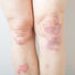 Jenseits der Plaque-Psoriasis: Molekulare Profile leiten personalisierte Therapieansätze